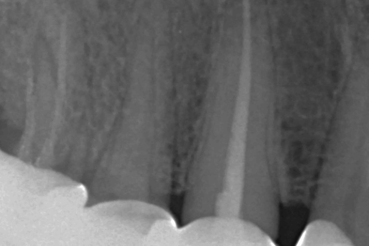 Endodoncia